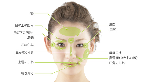 ヒアルロン酸の注入部位